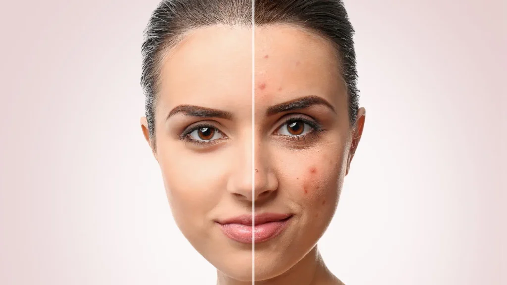مقایسه صورت قبل از استفاده ضد جوش و بعد از آن